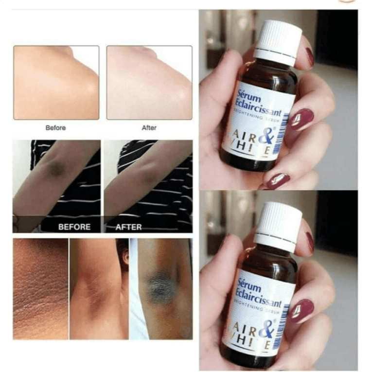 Fair And White Original Dark Spot Serum - Formulated To Fade Dark Spots On Face, Body, Hands, Elbows, Knuckles