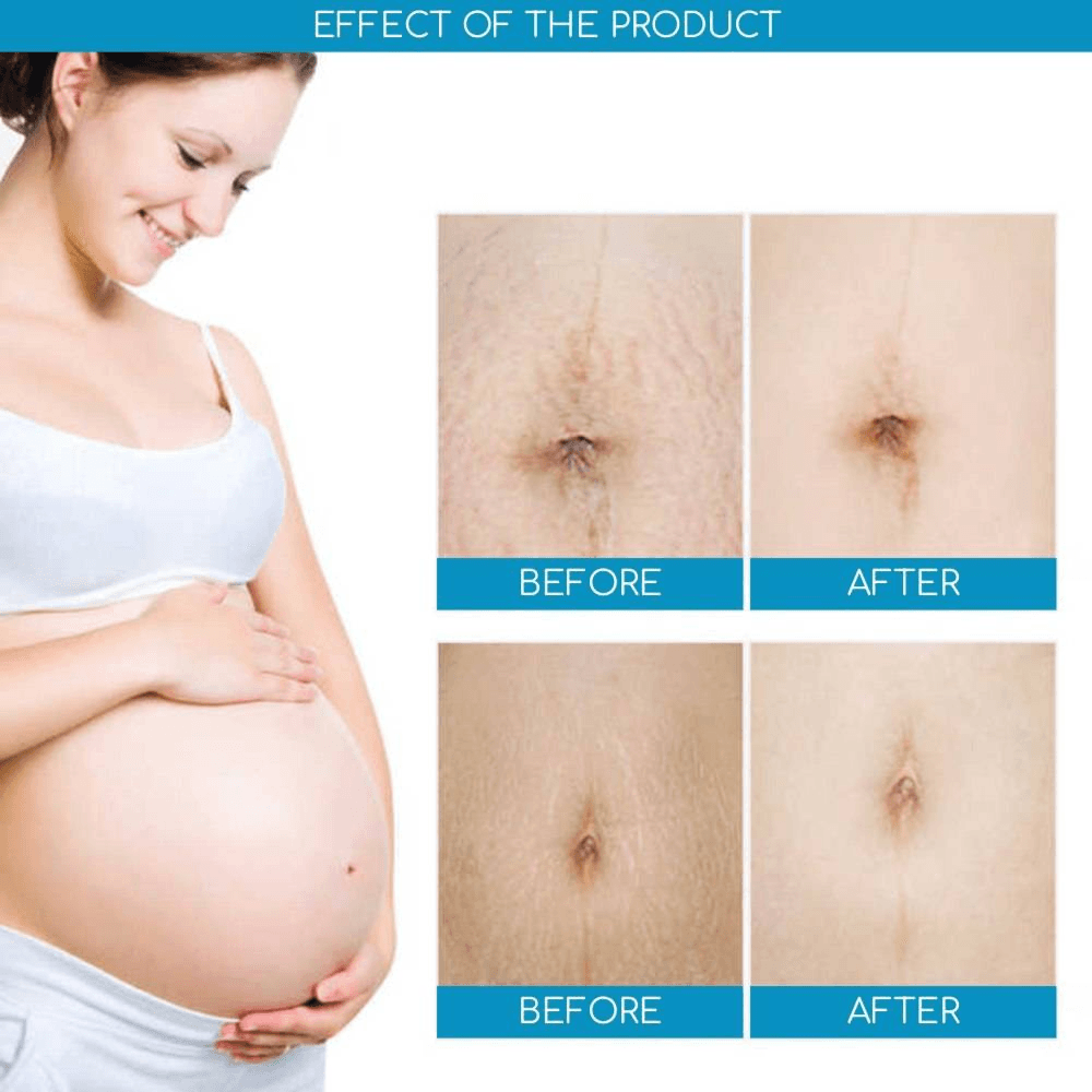 Aichun Beauty Anti-Stretch Mark Cream